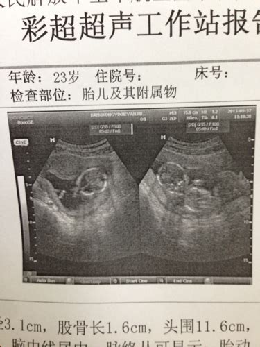 怀孕8周b超能看出什么