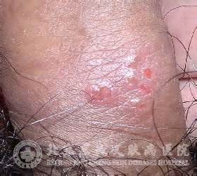 病毒性疱疹怎么治疗