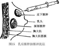 乳头肿痛与更年期