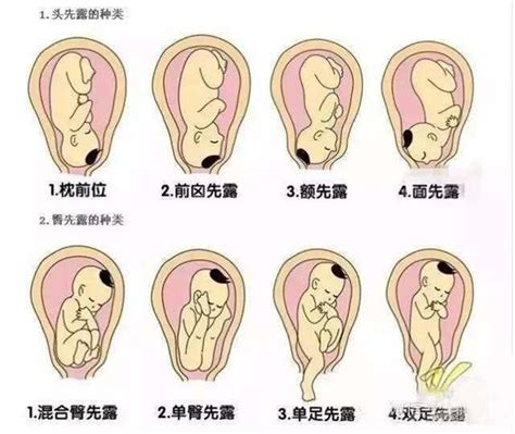 怀孕5个月发现兔唇宝宝还能要吗?