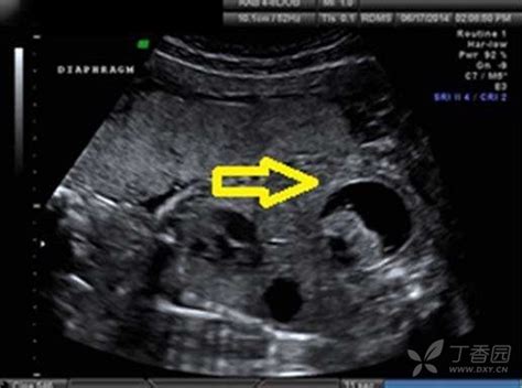 孕31周胎儿肠管扩张10mm