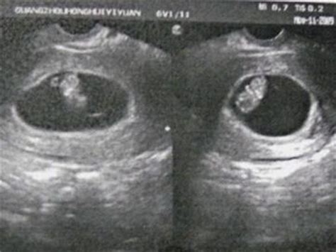 孕囊周边可见液性暗区