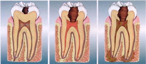 牙疼会使牙龈疼吗