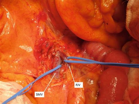 聚焦剖腹产（Cesarean