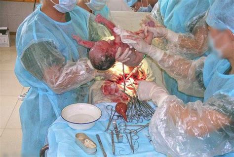 怀孕女人做羊膜穿刺