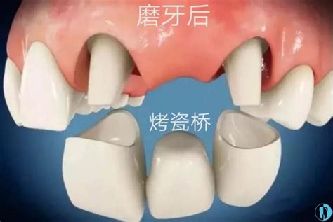 活动假牙表面光滑是怎么弄的