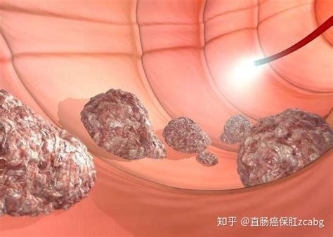 肛周一圈发红有烧灼感