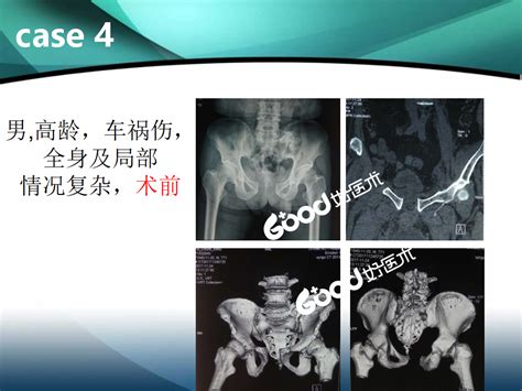 耻骨联合3d动画