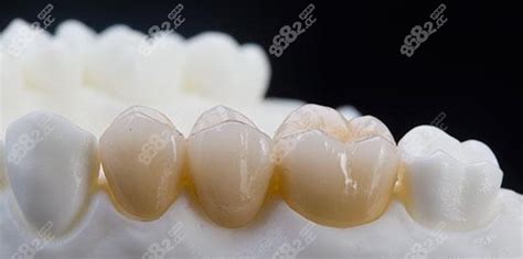 全瓷牙:鑄瓷牙和氧化鋯牙的區別和好壞？及各自的價位？