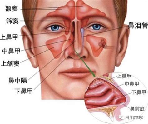 鼻炎鼻涕里有脓块