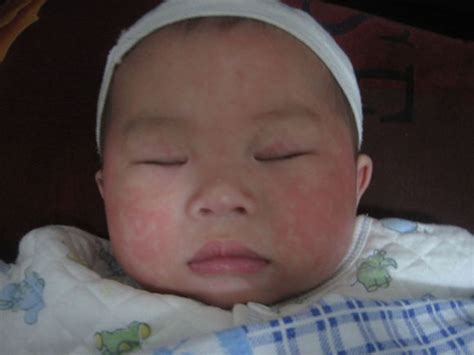 宝宝发烧出疹子就是幼儿急疹吗