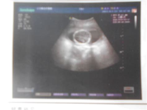 怀孕45天的b超单子图片
