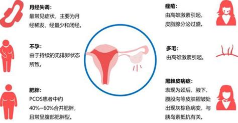 多囊卵巢会排卵吗