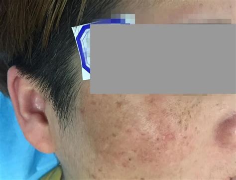 两个乳房中间长了褐色的斑