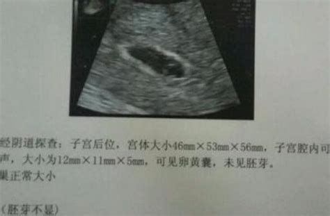 孕37周入盆有什么征兆