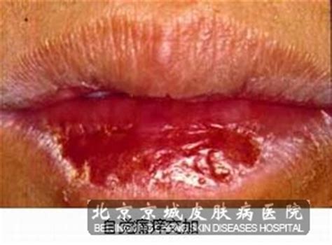 嘴唇特别干裂是什么原因造成的