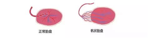 帆状胎盘能撑到足月吗