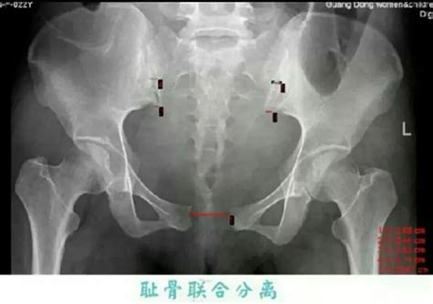 男人耻骨位置阵阵疼痛