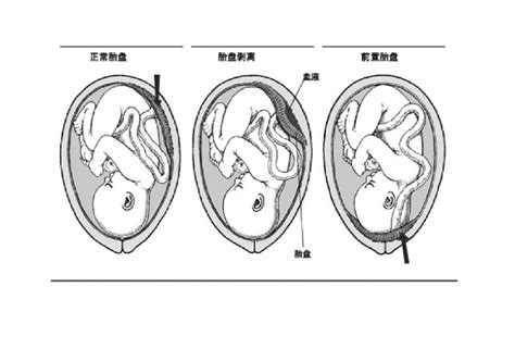 1级胎盘一般能撑多久