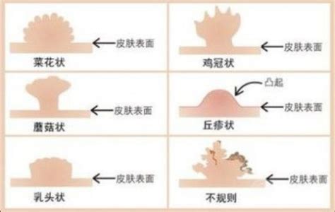 如何预防妊娠期尿道感染