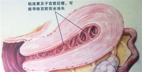 什么是宫腔积液?
