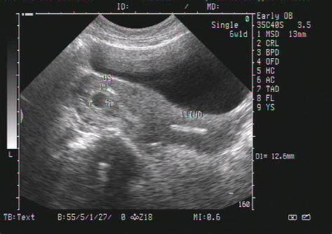 怀孕多少天做b超可以看见孕囊