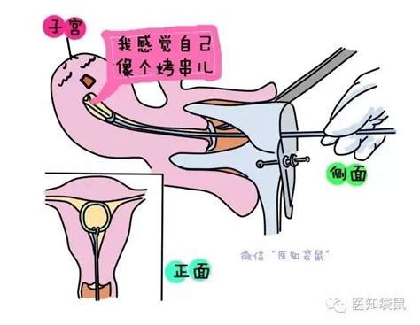 宫型环避孕效果好吗