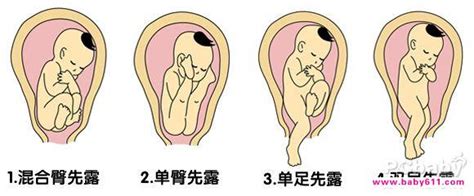 孕26周胎位臀位怎么办