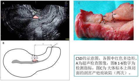 剖腹产宫缩25天突然疼