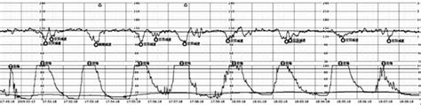 胎心监护曲线图有问题