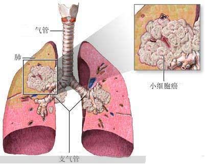 肺纤维化是不是肺癌