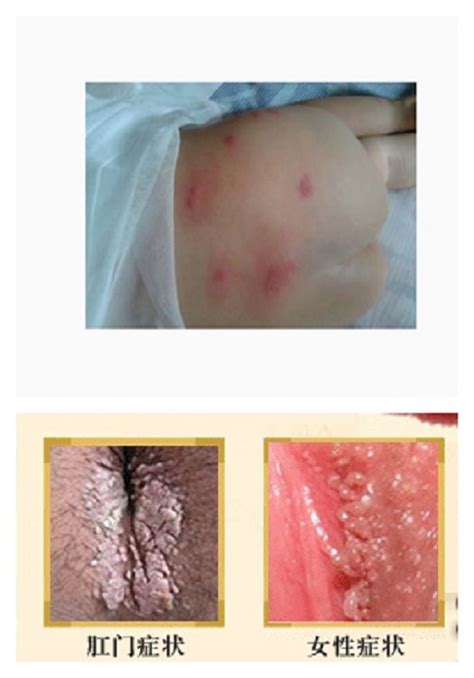 怀孕初期痔疮出血要不要紧