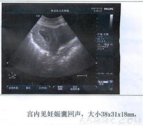 胎儿偏小2周彩超图片