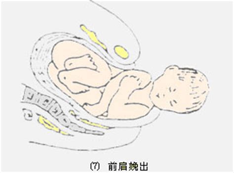 肩难产应做到