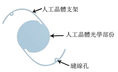 山西75岁白内障能报销吗