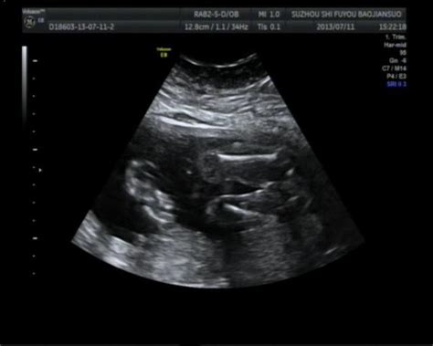 孕期B超单怎么看胎儿性别