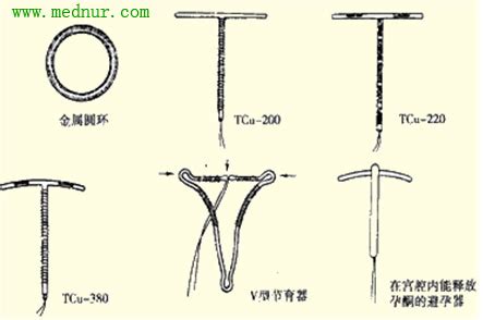 带环宫外孕后需要取环吗