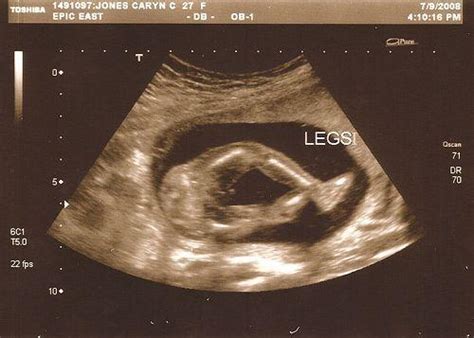 肚子圆尖能看出胎儿性别吗