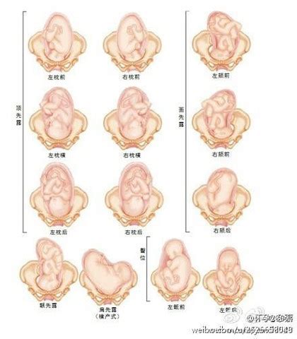 rsp胎位在肚子里的图片