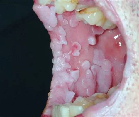 hiv感染初期舌苔有什么症状