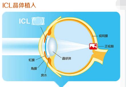 近视100度散光50严重吗