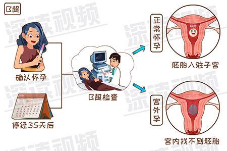 宫外孕不用药hcg会下降吗