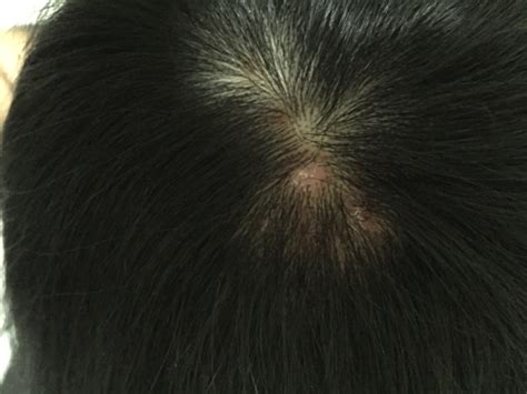 狗秃了一块毛多久恢复