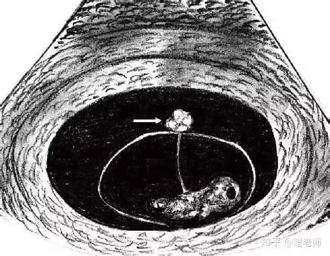 怀孕生气会导致卵黄囊增大吗