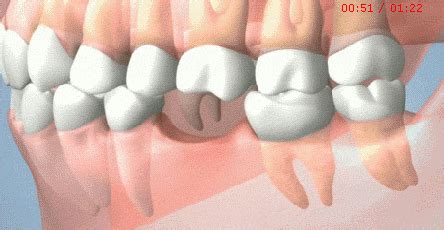 种牙植骨的危害