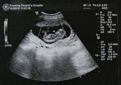 孕9周宝宝b超图