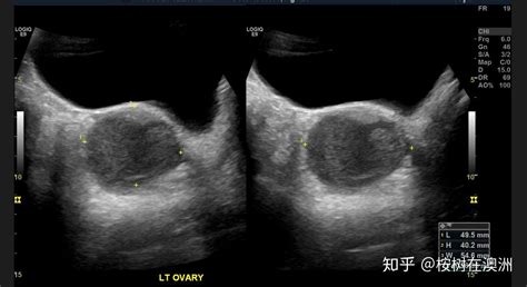 巧克力囊腫一定要手術嗎