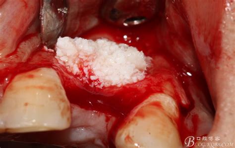 牙槽突裂植骨手术费用上海