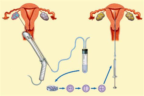 试管婴儿能否成功