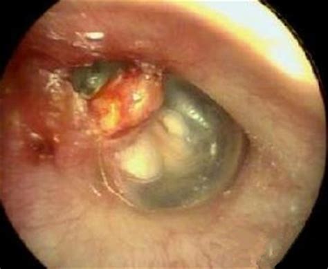 耳膜修复后听力能恢复正常吗
